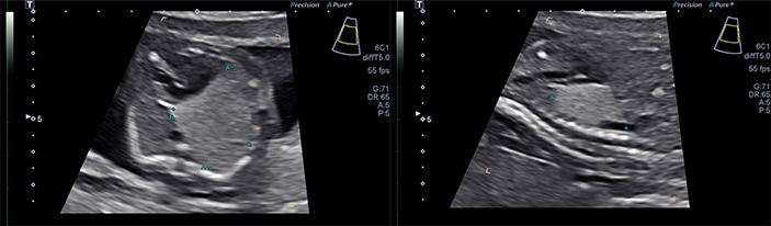 An ultrasound