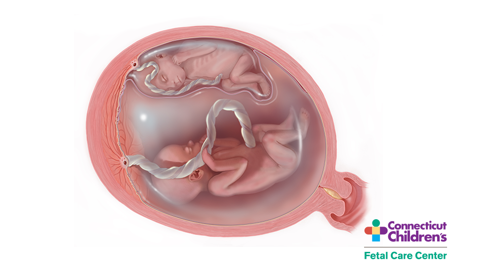 Medical Illustration of Twin-Twin Transfusion Syndrome