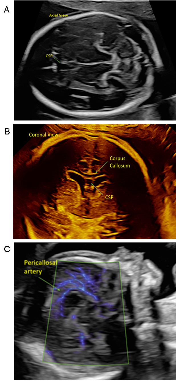Normal Ultrasound Views of Corpus Collosum