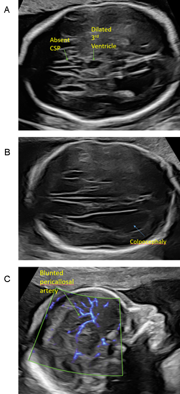 Abnormal Ultrasound Views in Agenesis of the Corpus Collosum