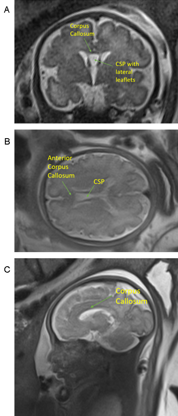 Normal MRI of the Corpus Collosum and CSP