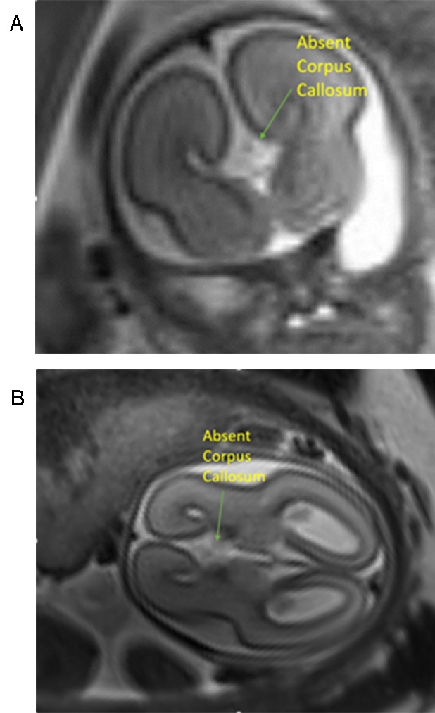 Abnormal MRI consistent with Agenesis of the Corpus Collosum