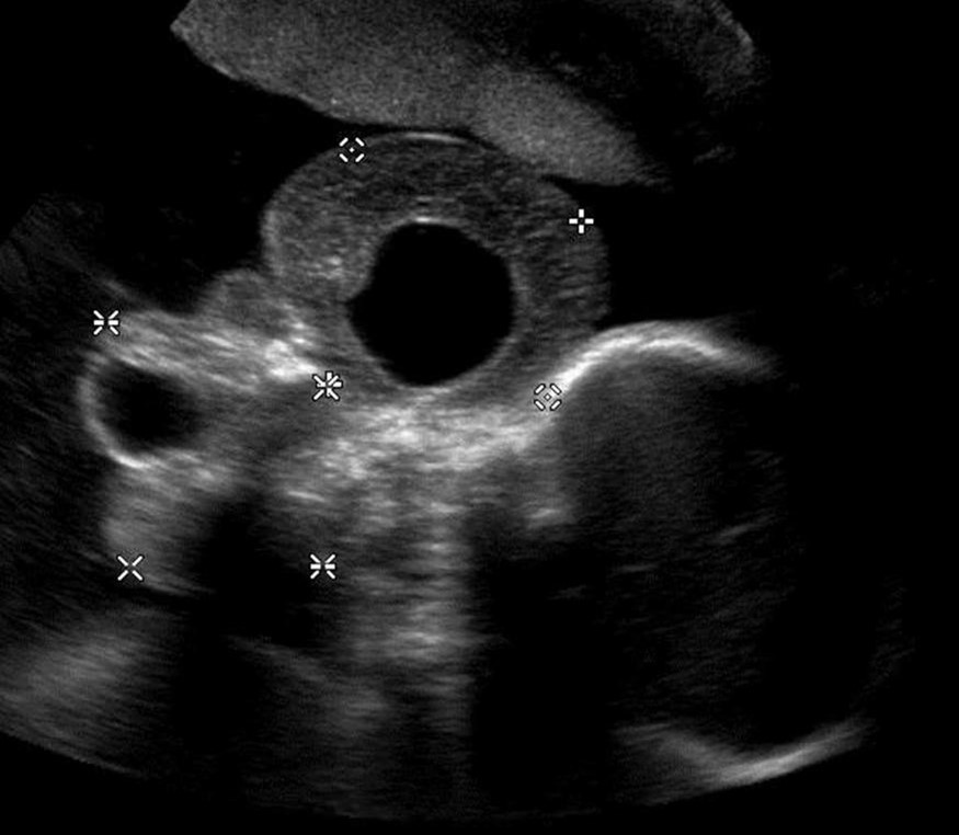 Sonographic imaging of epignathus