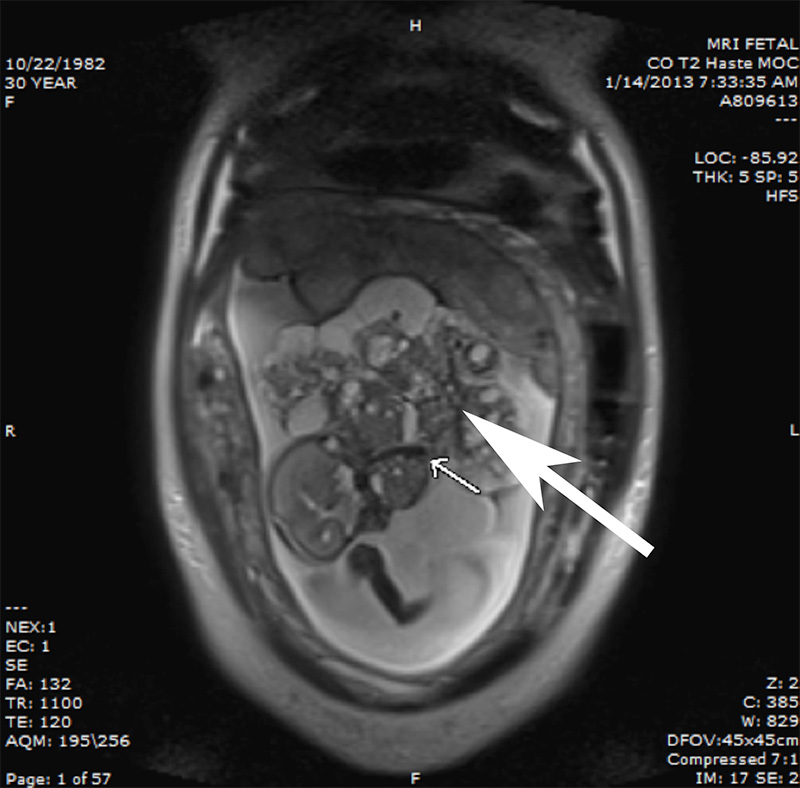 MRI of epignathus