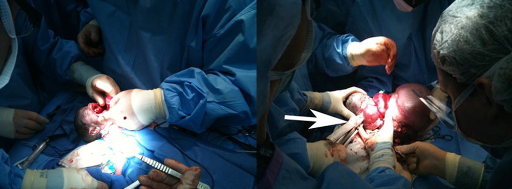 Epulis and Epignathus fetal intervention