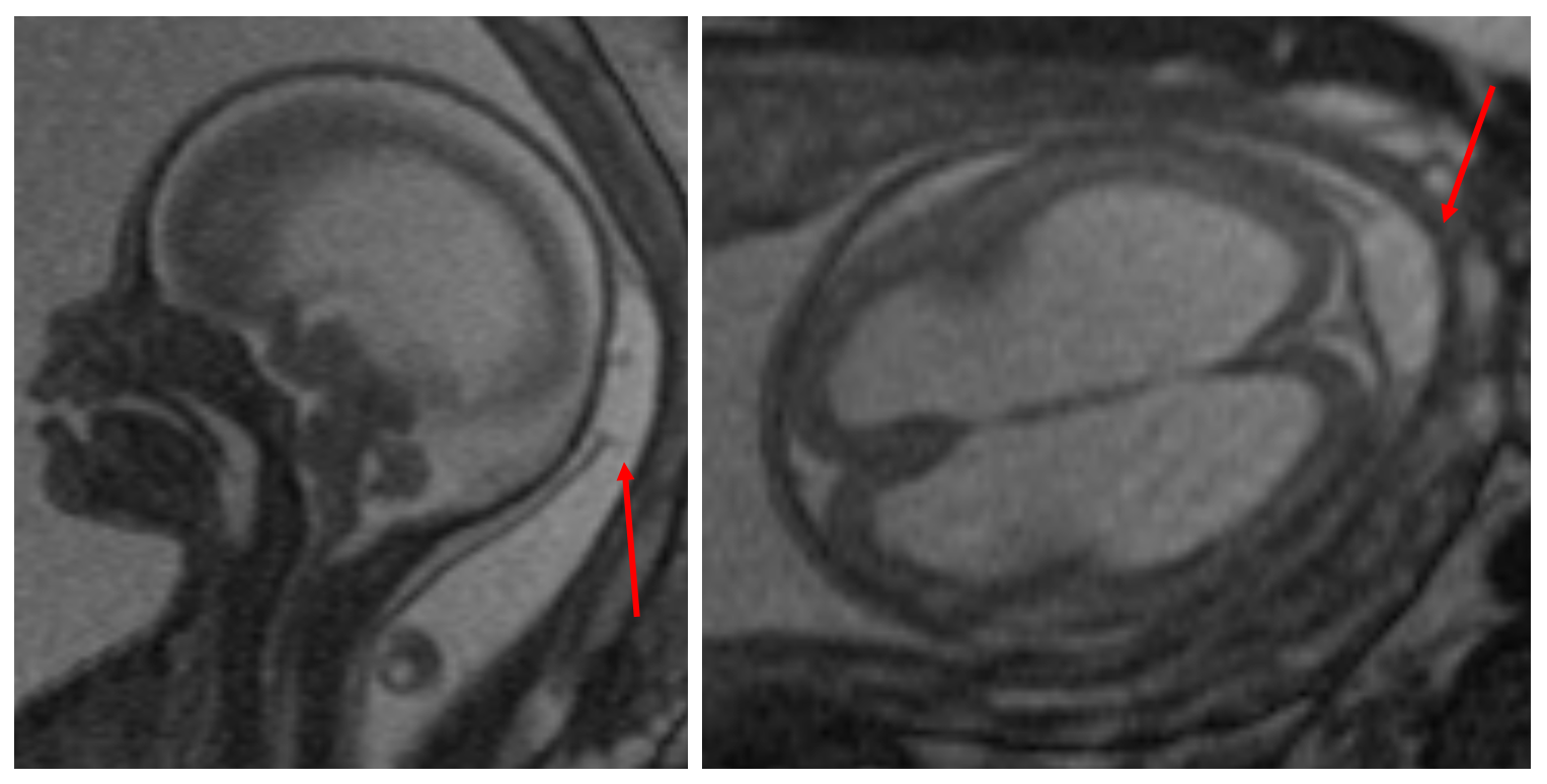 Prenatal MRI of a patient with encephalocele
