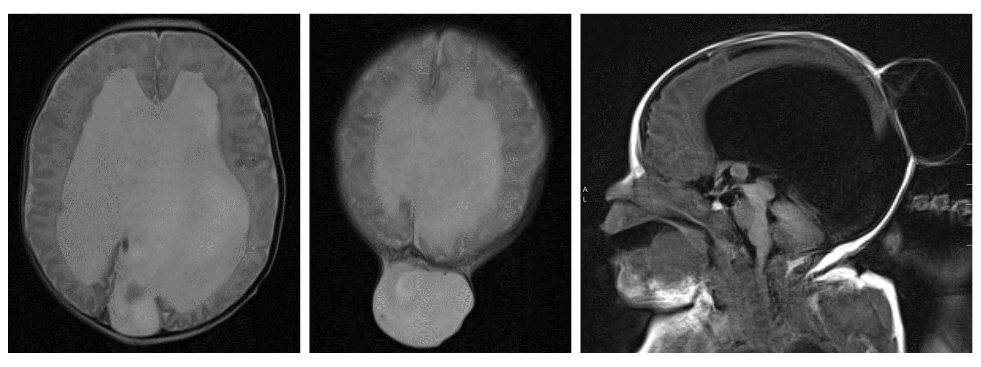 Postnatal MRI of a patient with encephalocele
