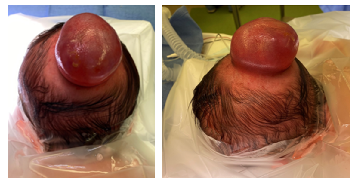 Prep for surgical intervention for a patient with encephalocele