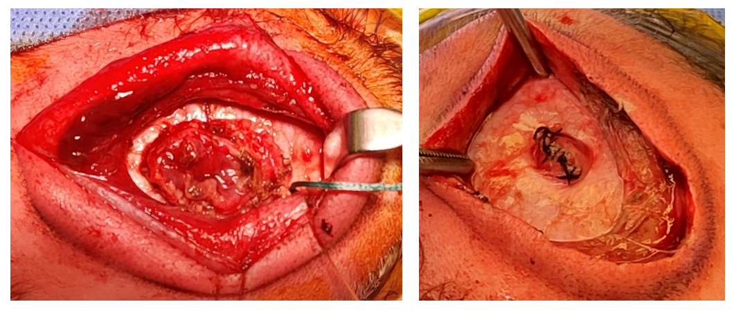 Watertight Dural Closure of Encephalocele