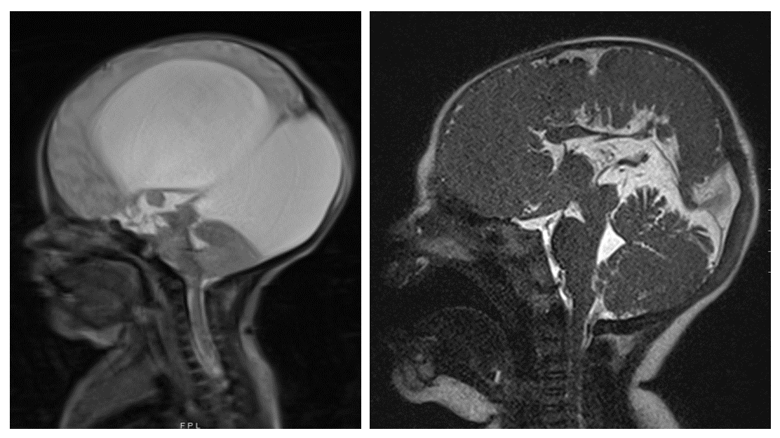 Post-op imaging of encephalocele patient