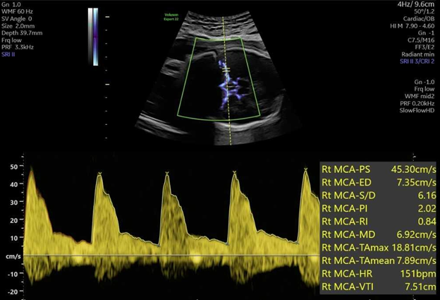 MCA Doppler