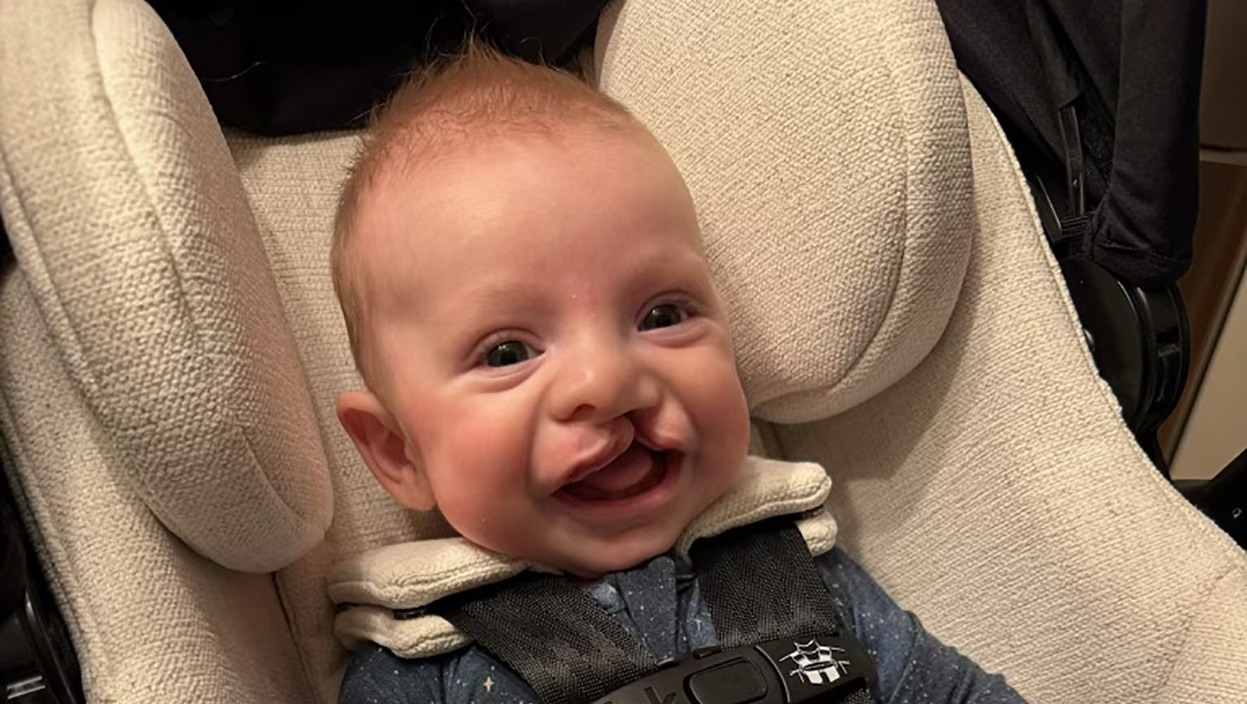 Craniofacial patient Tatum