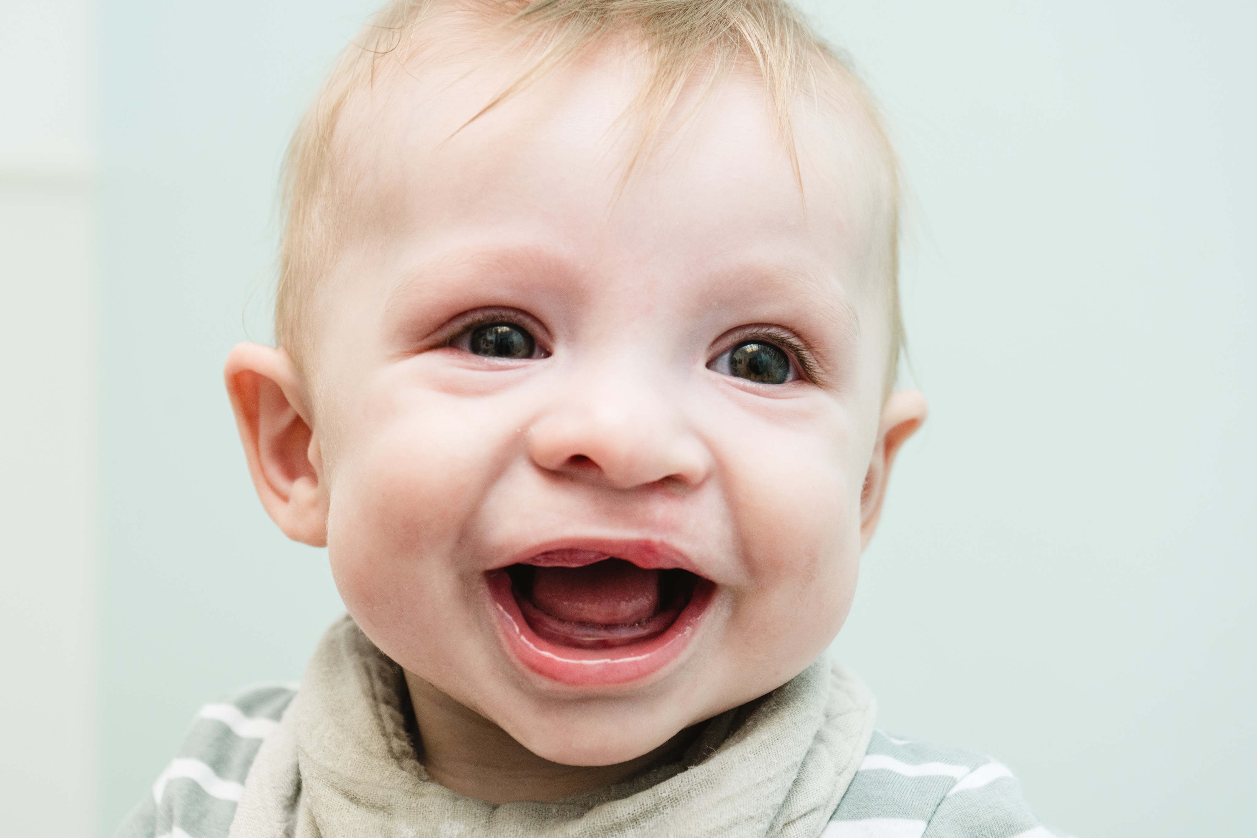 Craniofacial patient Tatum