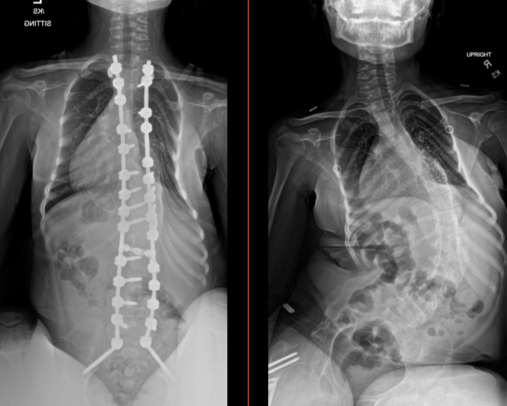 Patient story Amelia, family submitted photos