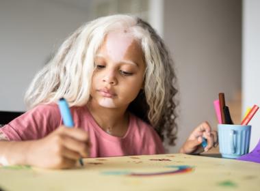 Girl with piebaldism drawing