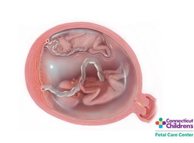 Medical Illustration of Twin-Twin Transfusion Syndrome