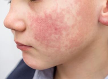 Boy with red, lacy rash on cheek, human parvovirus, fifth disease or slapped cheek syndrome