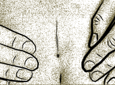 Medical illustration of coccygeal pit