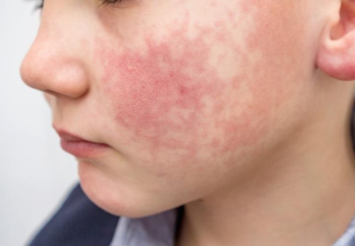 Boy with red, lacy rash on cheek, human parvovirus, fifth disease or slapped cheek syndrome