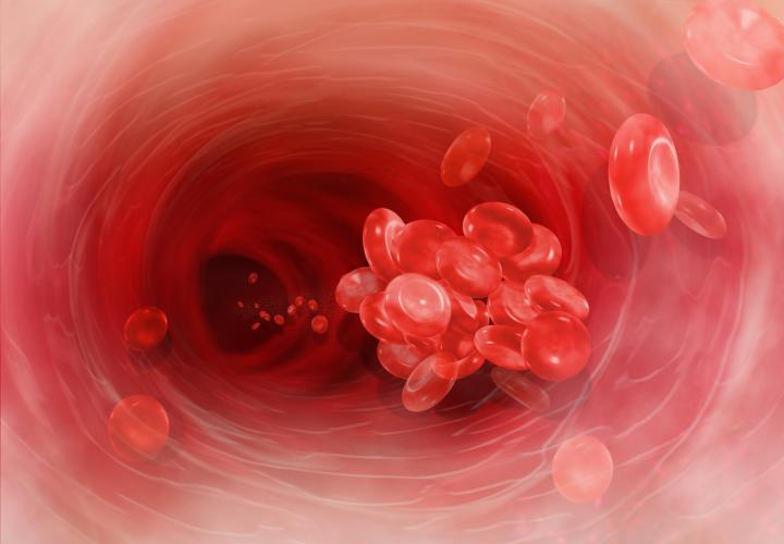 Blood clot illustration in artery. How to spot a blood clot in kids
