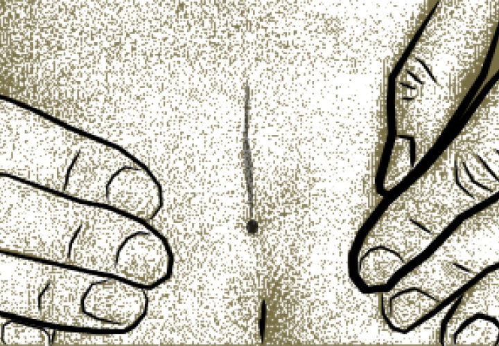 Medical illustration of coccygeal pit