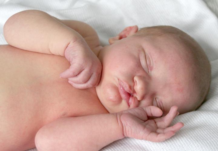 Cleft and lip palate newborn baby