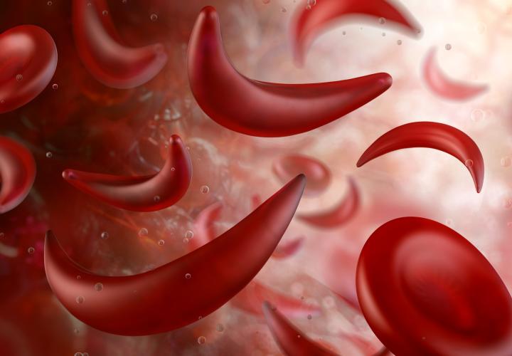 Sickle cell anemia deformed red blood cells