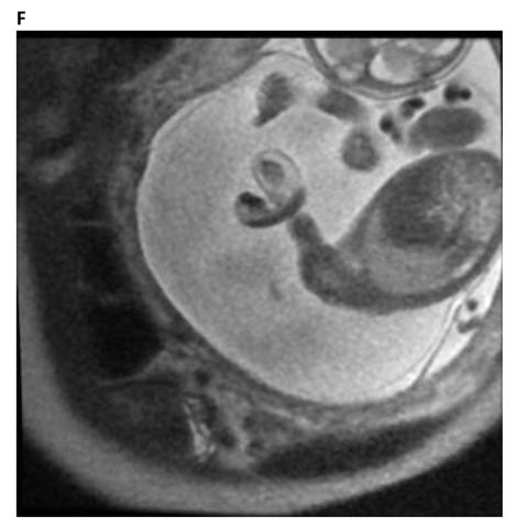 How We Monitor and Treat Amniotic Band Syndrome