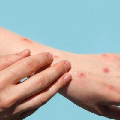 Monkeypox