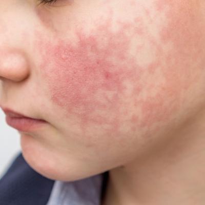 Boy with red, lacy rash on cheek, human parvovirus, fifth disease or slapped cheek syndrome