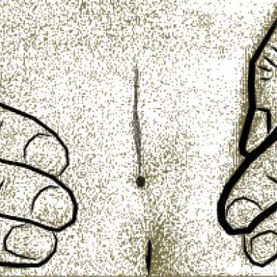 Medical illustration of coccygeal pit