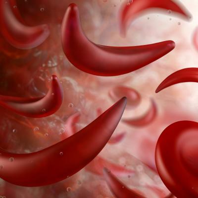 Sickle cell anemia deformed red blood cells