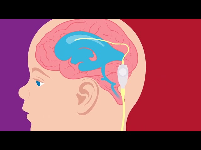 Drawing of a child's brain with catheter